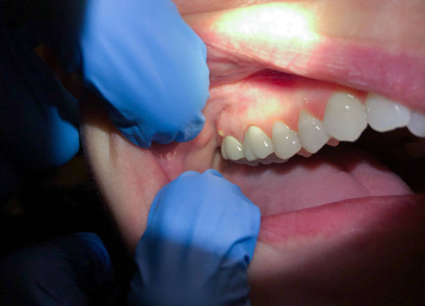 Best Emergency Wisdom Teeth Removal in Pigeon Forge, TN